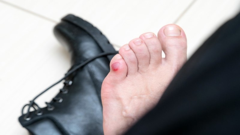 How To Treat Blood Blister in Natural Way